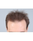Before Hair Transplant&nbsp;2 Sessions (Areas)
